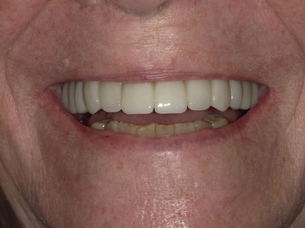 Full-arch implant restoration — after treatment