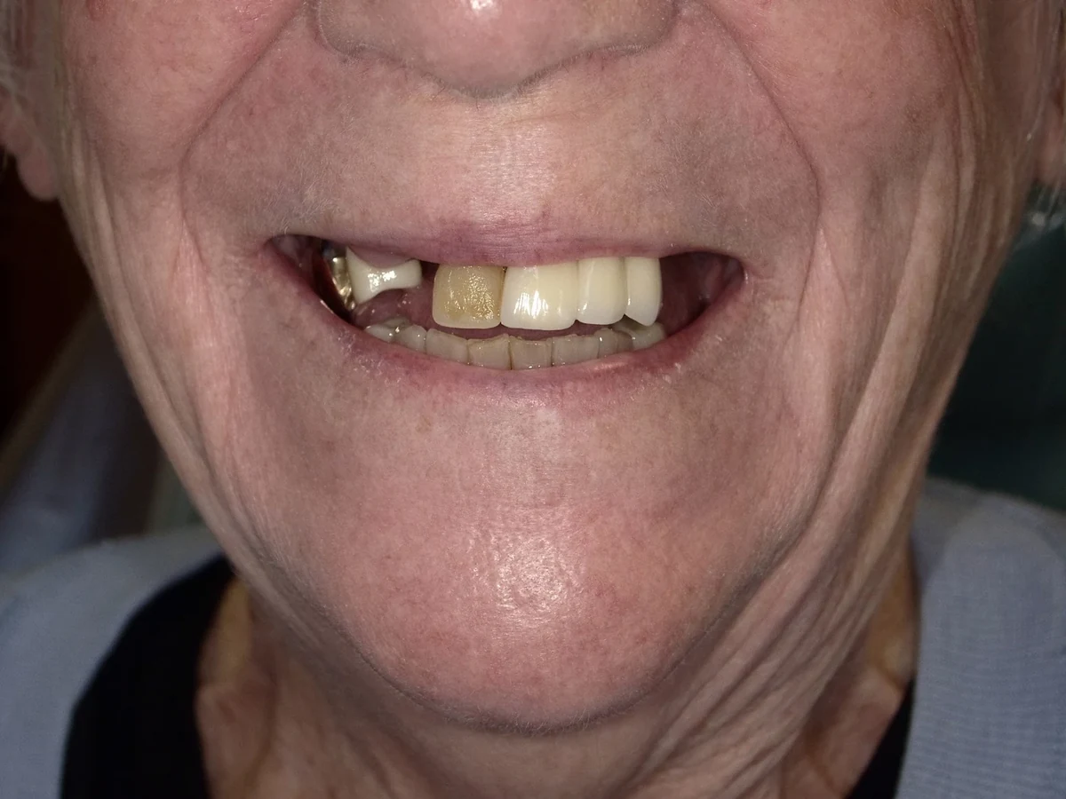 Full-arch implant restoration — before treatment