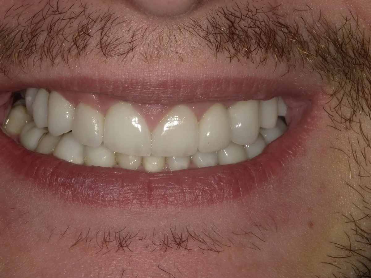 Cosmetic veneer treatment — after treatment