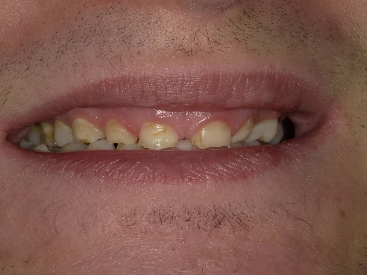 Cosmetic veneer treatment — before treatment