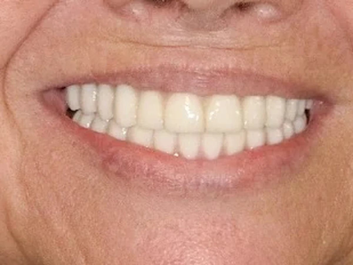 Full-mouth reconstruction — after treatment