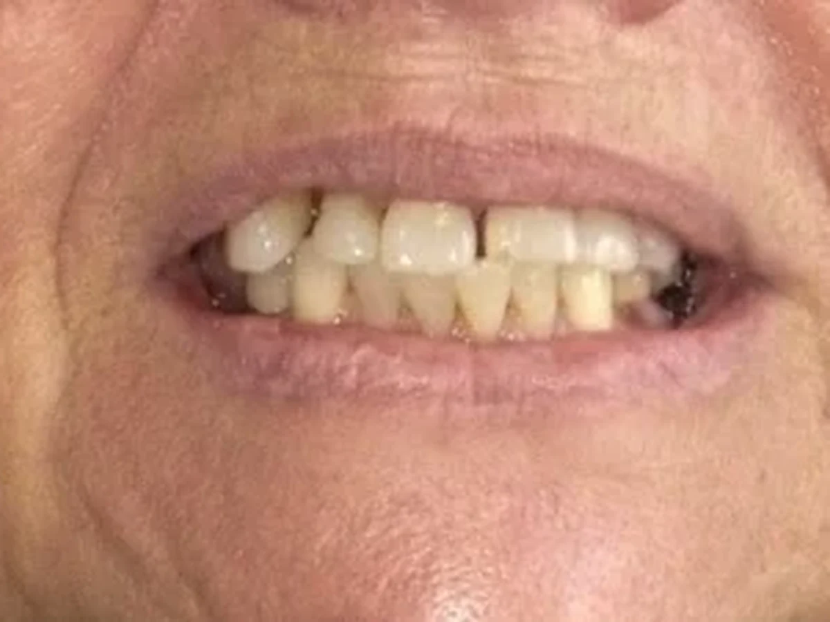 Full-mouth reconstruction — before treatment