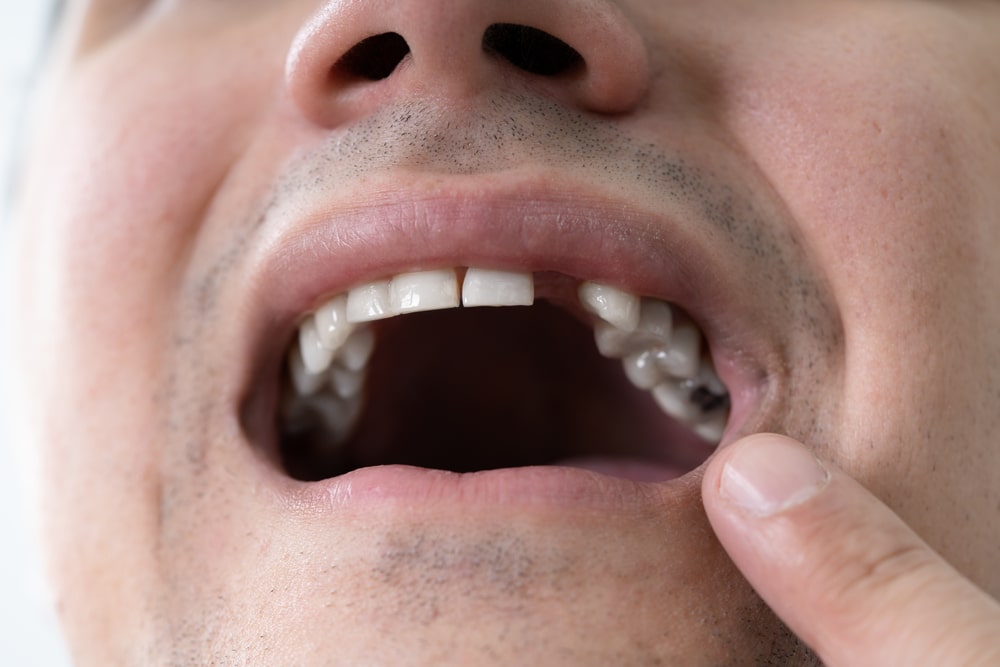 Man with missing teeth in Herrin